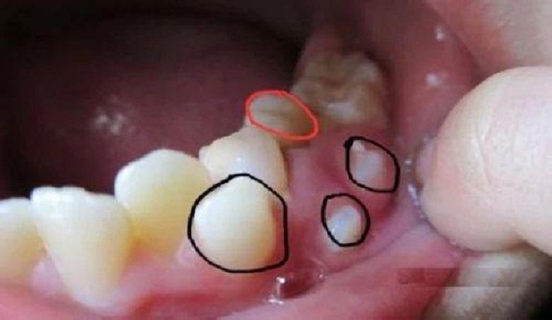 牙根囊肿 快懂百科