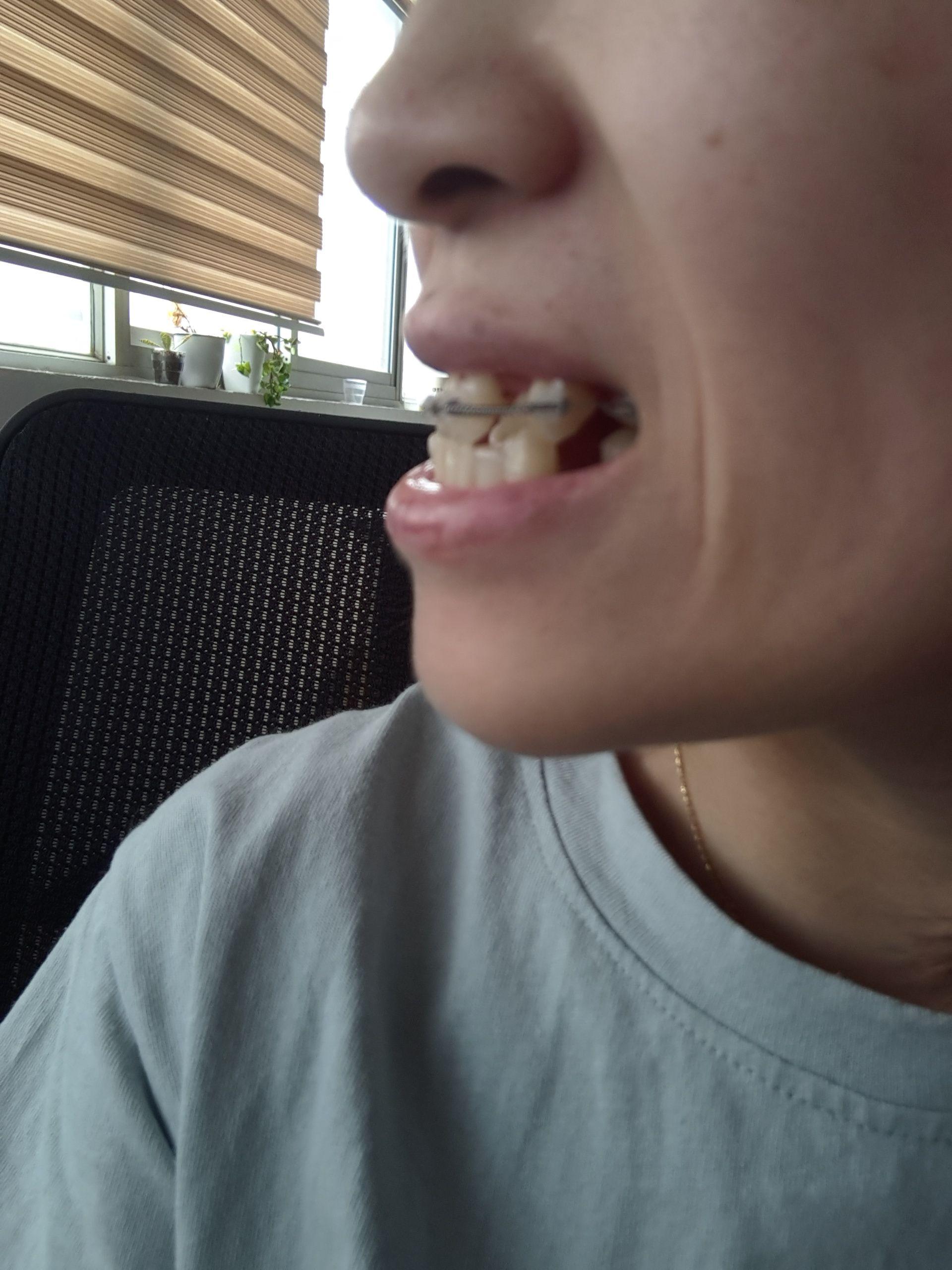 地包天矫正术 快懂百科