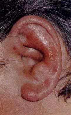 耳廓软骨膜炎