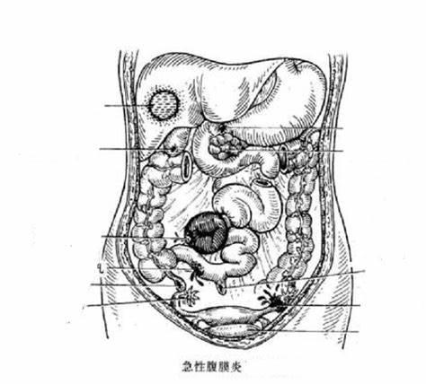 急性腹膜炎