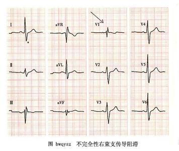 束支传导阻滞 快懂百科