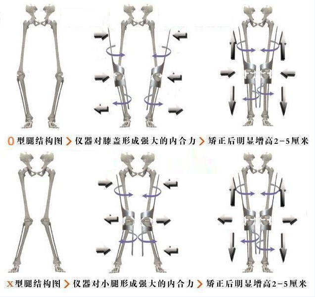 O型腿矫正 快懂百科