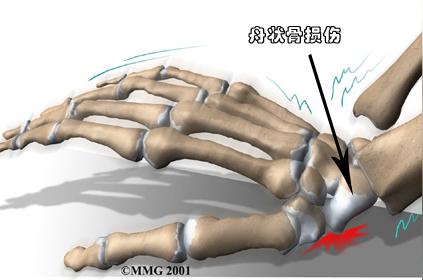腕舟状骨骨折 由间接暴力致伤 头条百科
