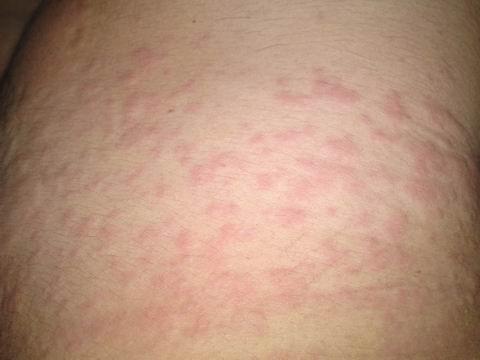 皮肤过敏症状 快懂百科