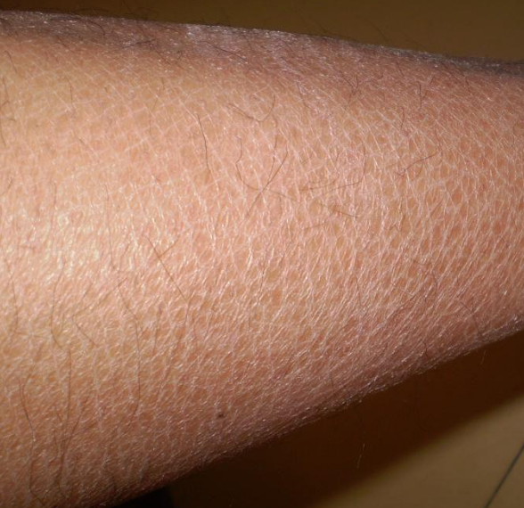 丑角样鱼鳞病 快懂百科