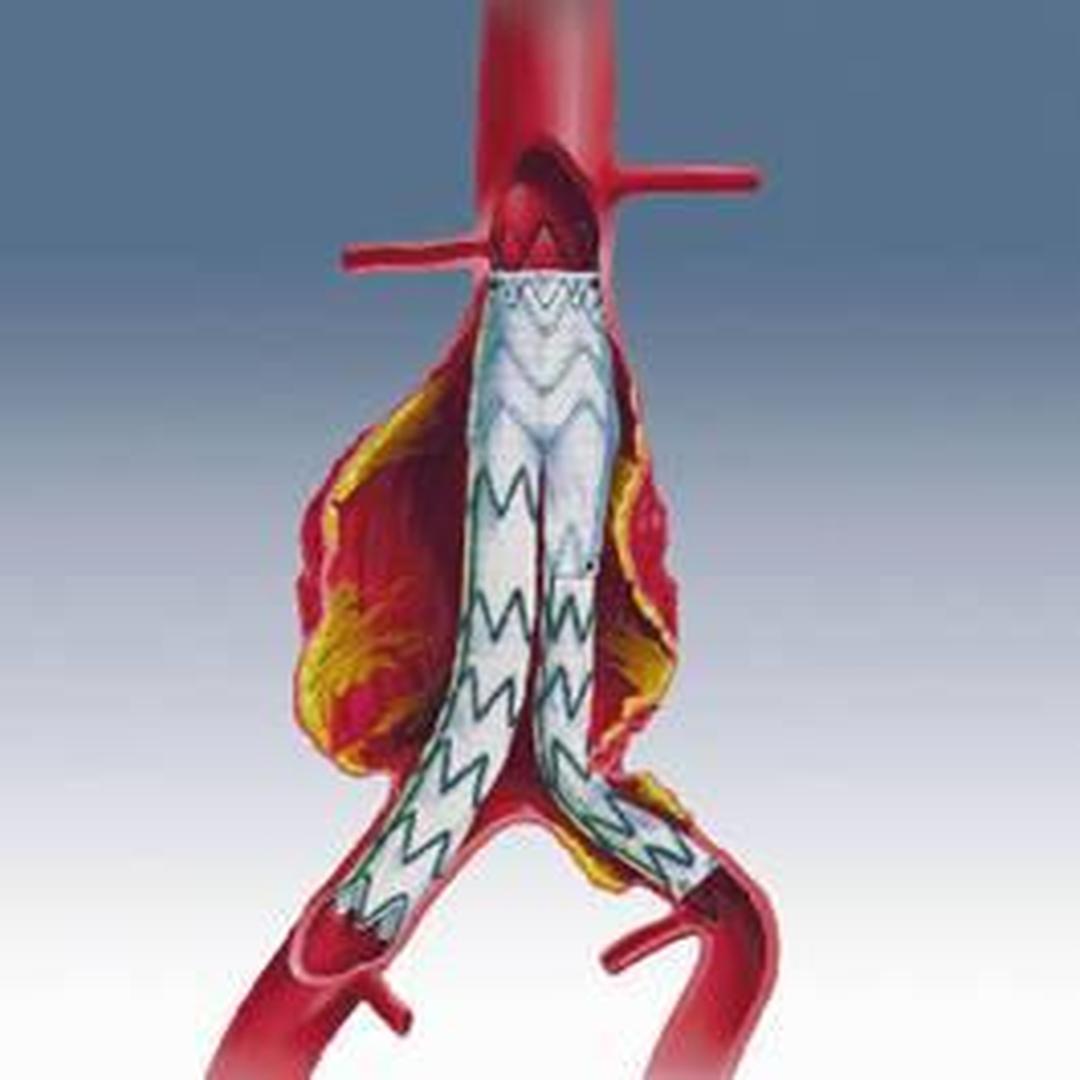 血管支架 放置图片