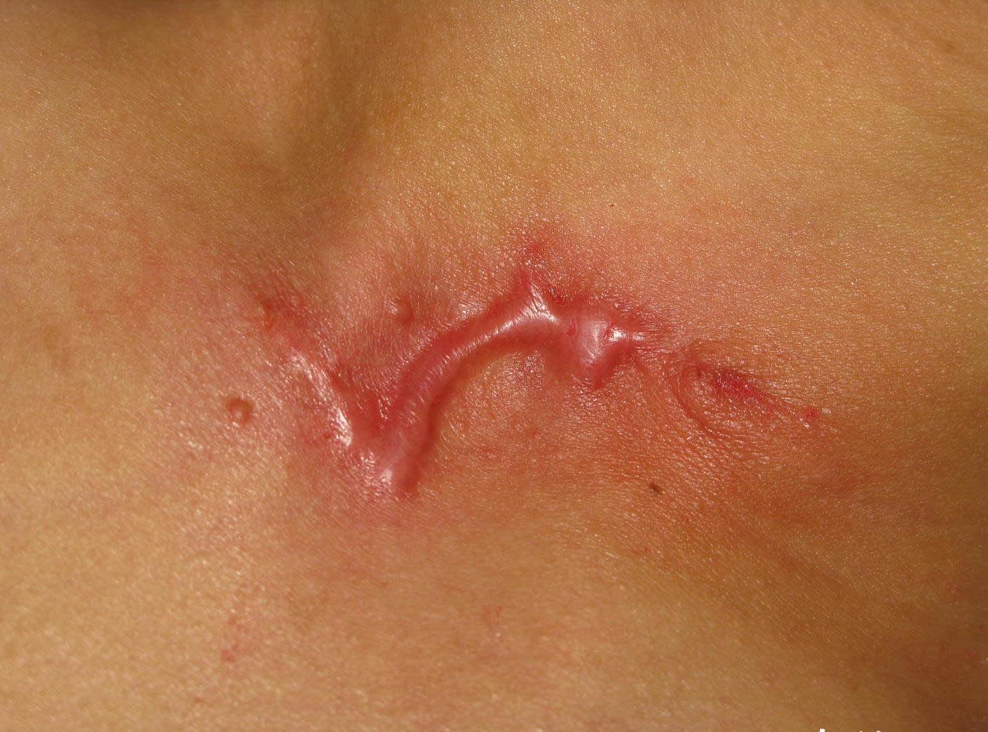 瘢痕修复- 快懂百科