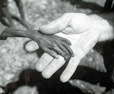 (图)日本发生的公害病──水俣病